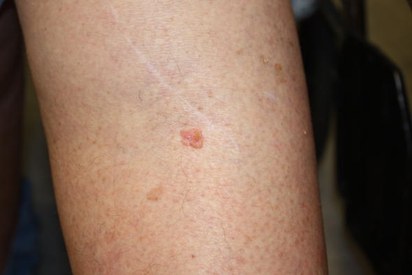 Photograph showing a person's leg with a skin cancer lesion that looks pink and raised.