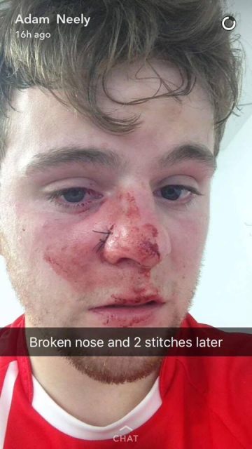 Donegal U21 star Adam Neely suffered a nasty injury last night. 