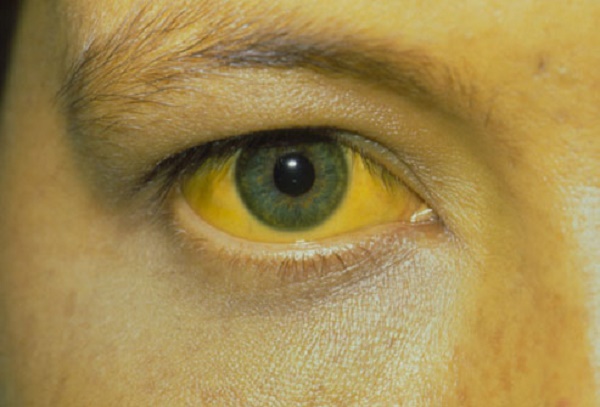 Yellowing of the eyes is a common symptom of hepatitis