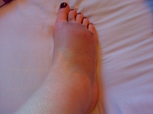 One fan's foot today after she was trampled