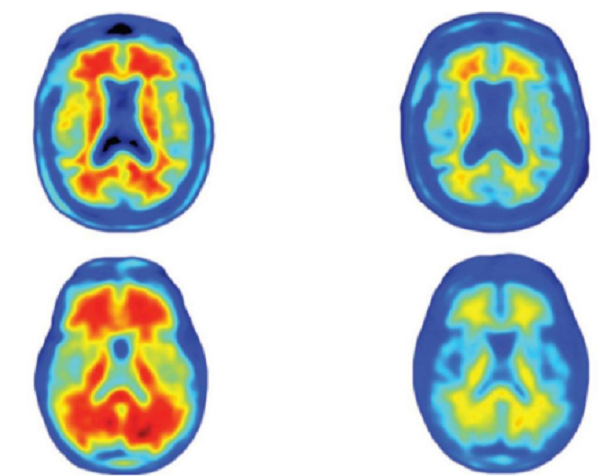 Brain scans of Alzheimer's patients who took part in the trial 