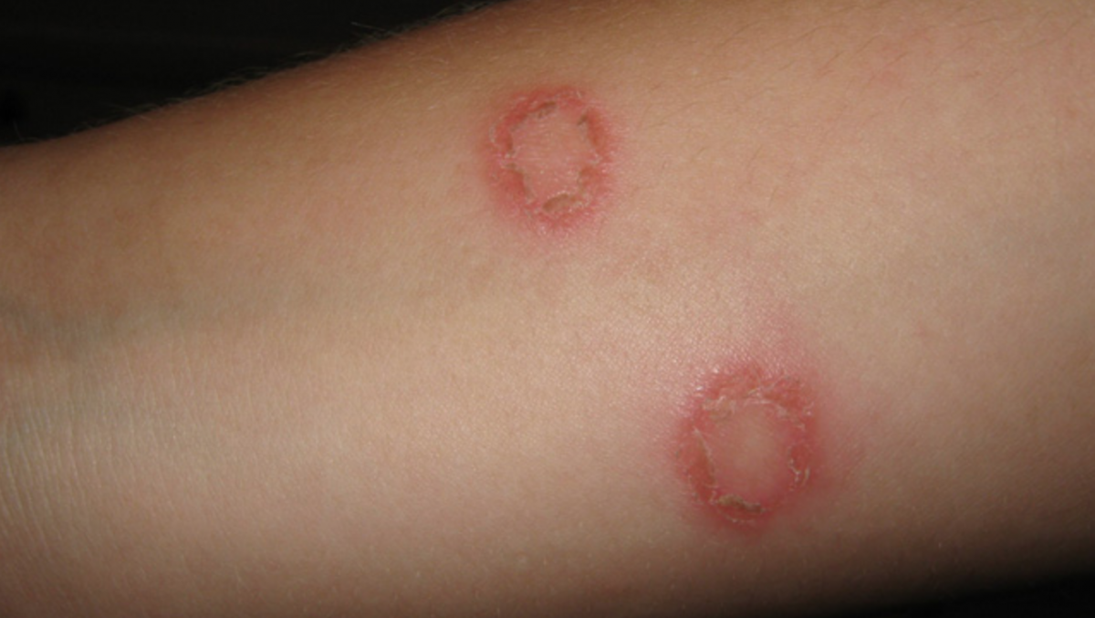 Home remedies for ringworm: 11 natural treatments