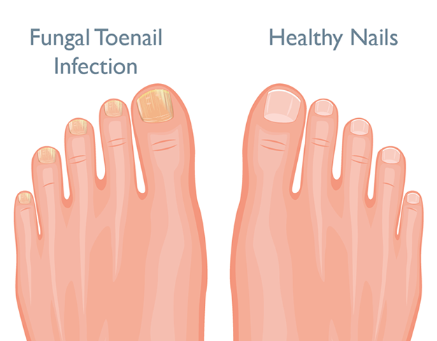 Medical Matters: How to treat fungal nail infections – Donegal Daily
