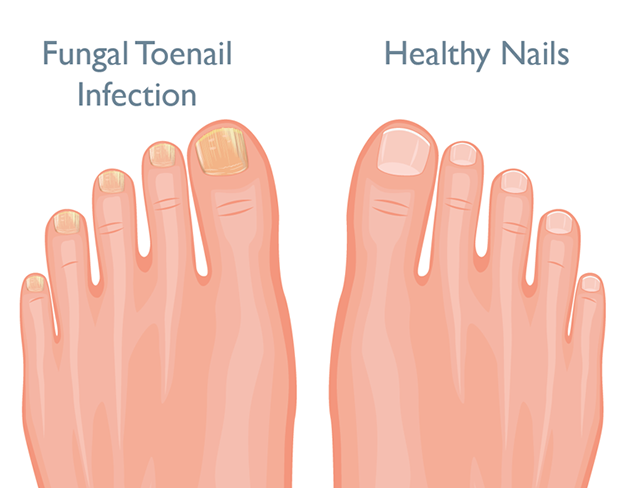 How to treat fungal nail effectively - The Pharmaceutical Journal